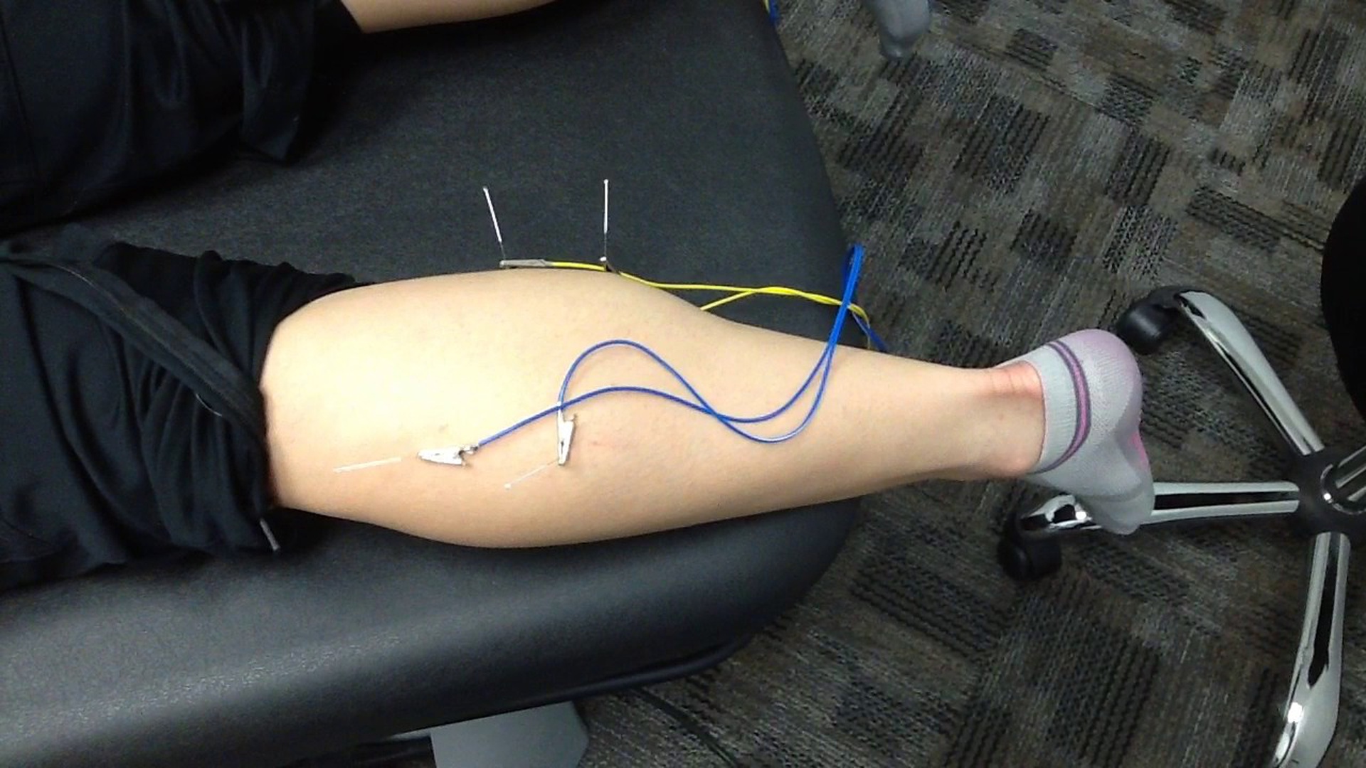 dry needling the calf how it works