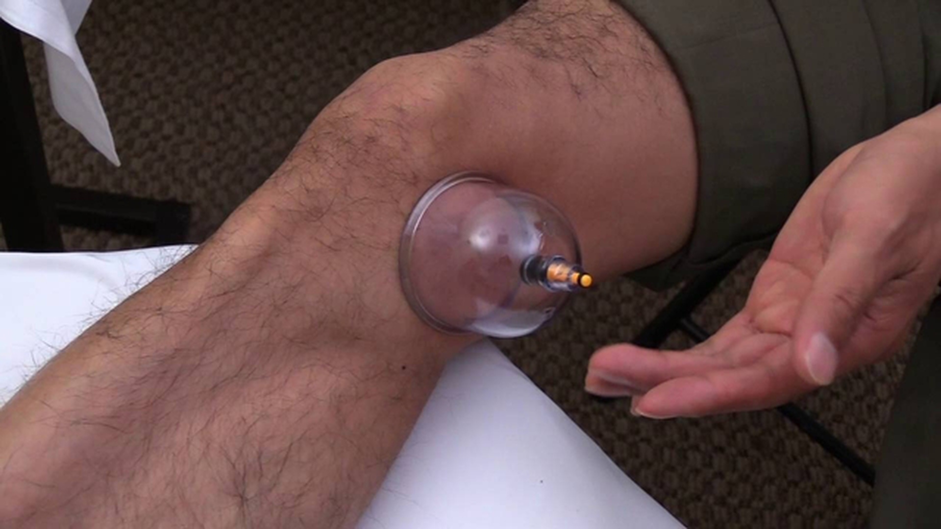 cupping therapy for knee pain
