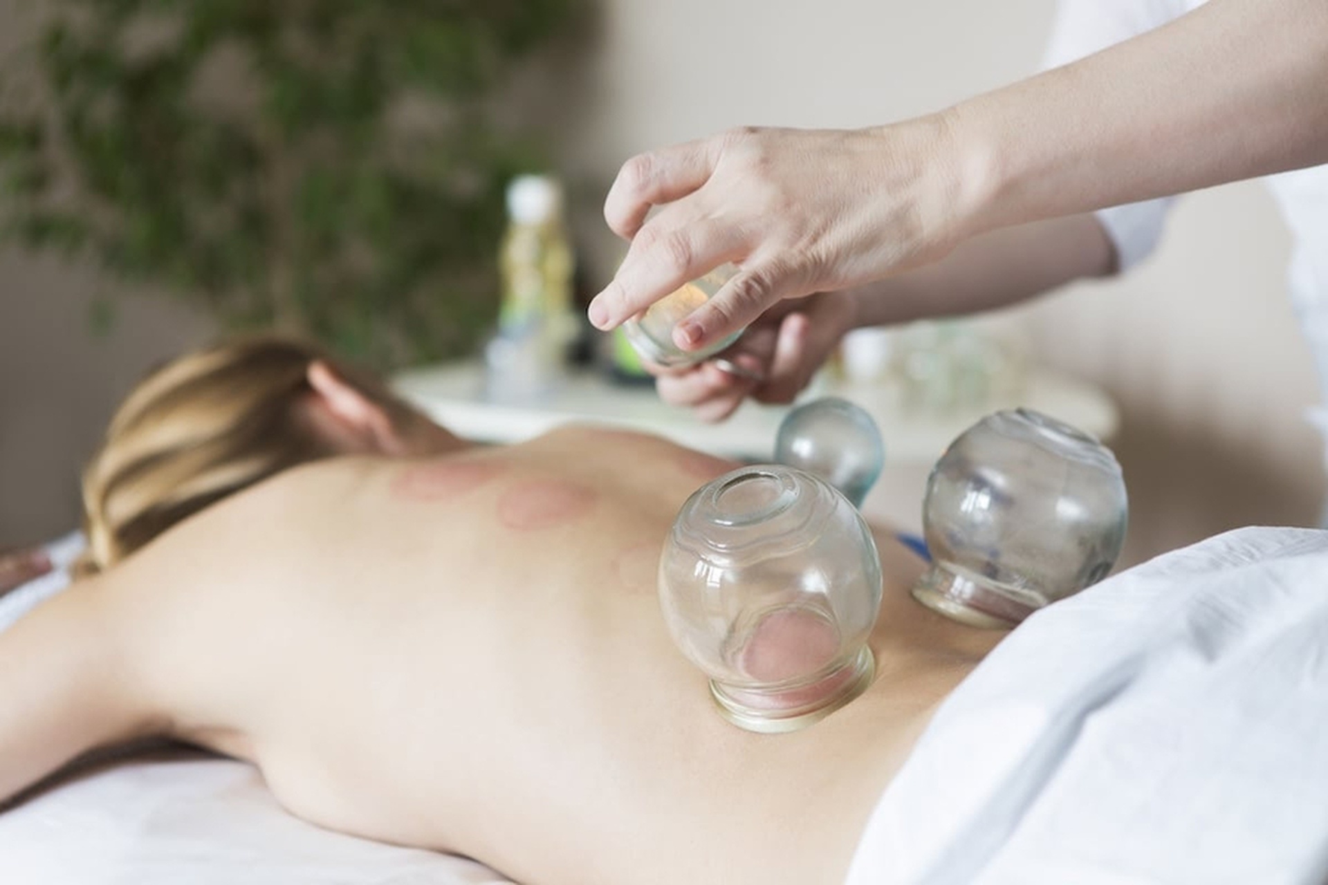 what are the side effects of cupping therapy things you should know