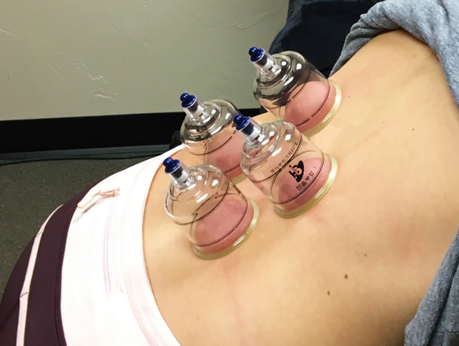 does cupping therapy work for sciatica