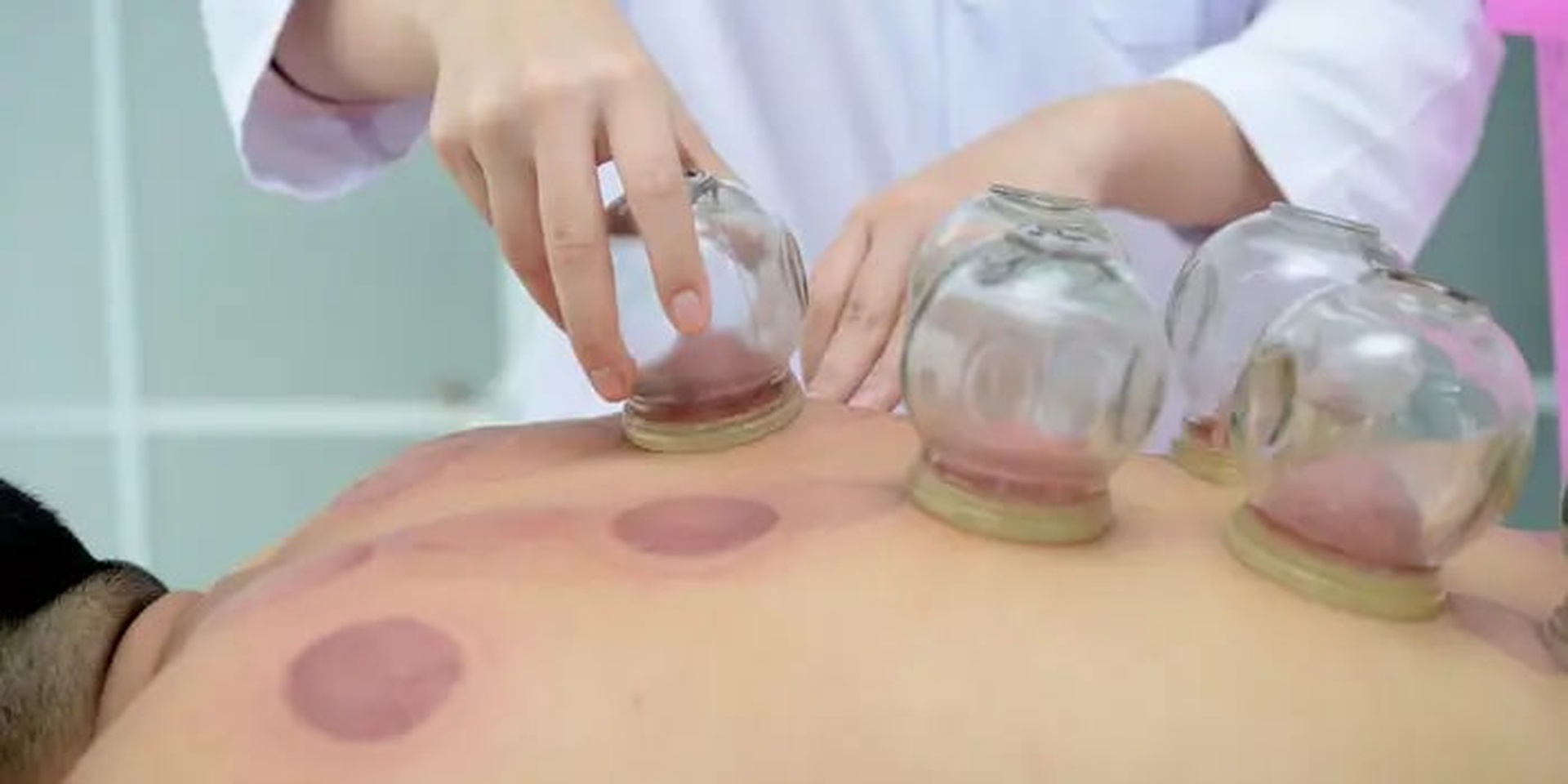 cupping therapy techniques explains how to benefits