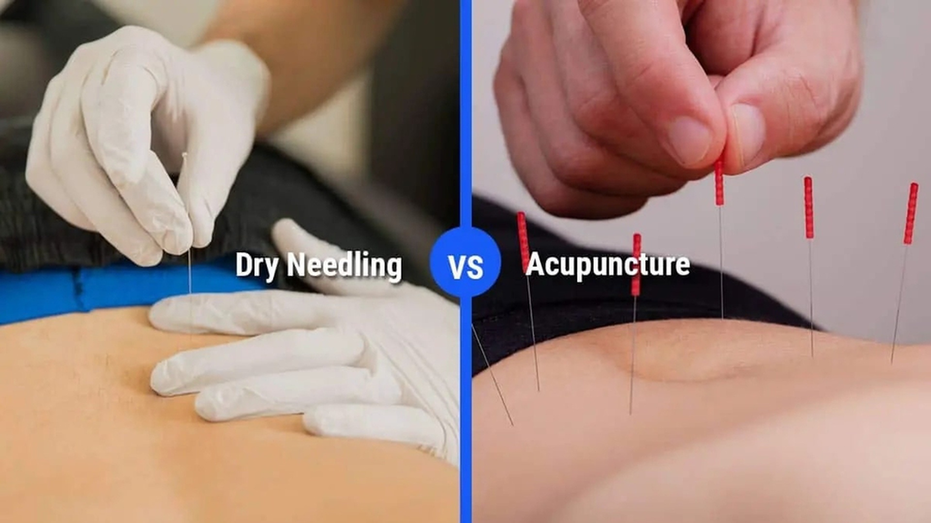 dry needling vs acupuncture what’s the difference