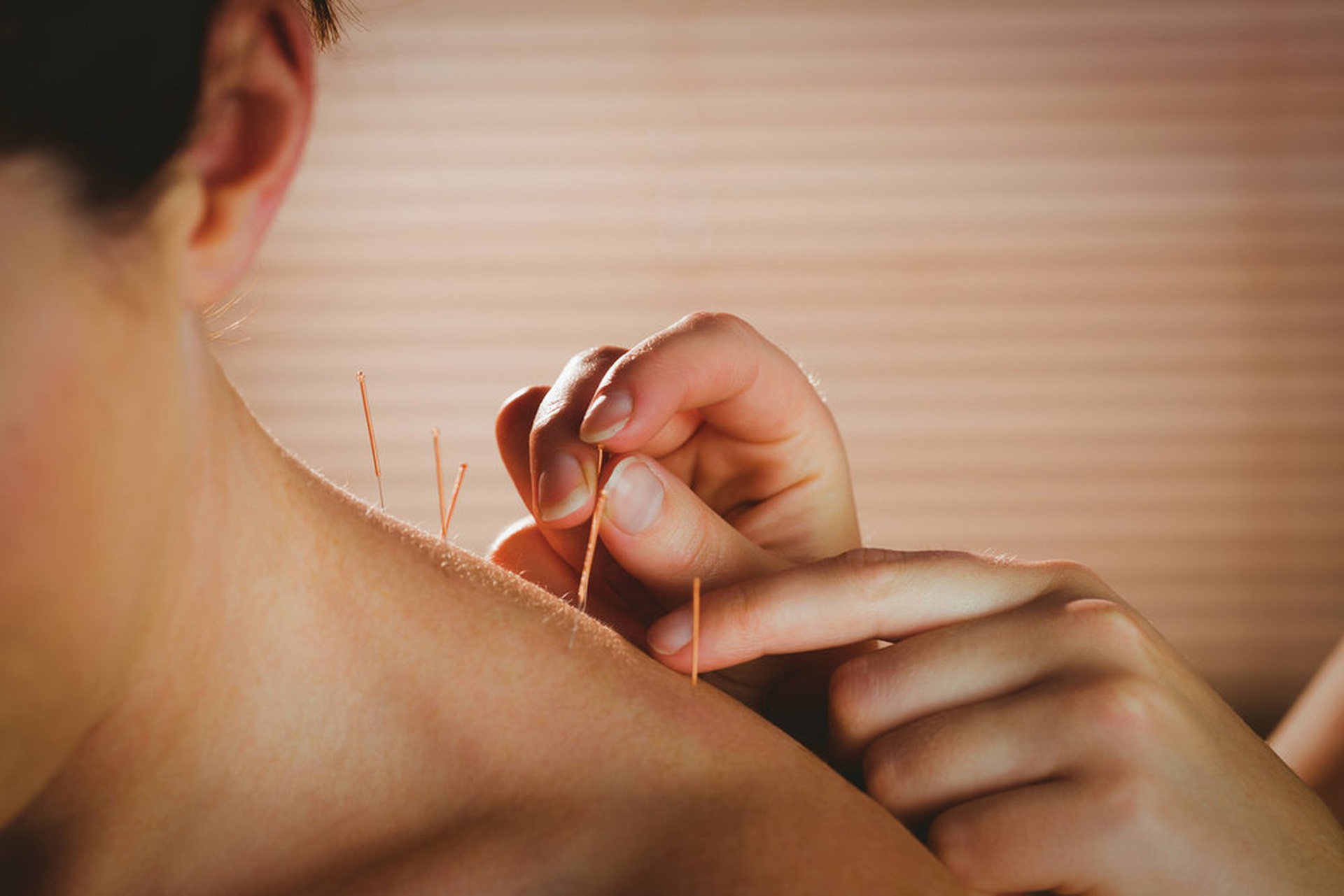 how does dry-needling work