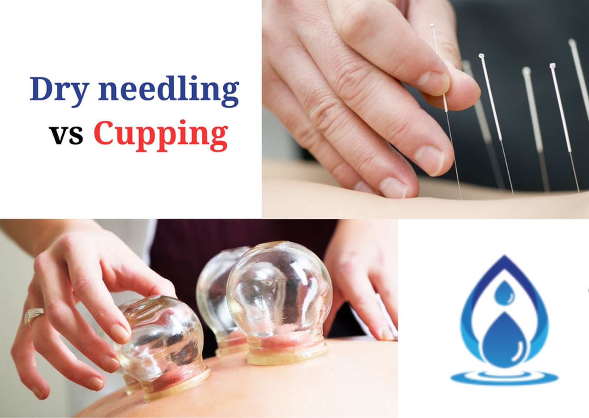 dry needling vs cupping what to choose