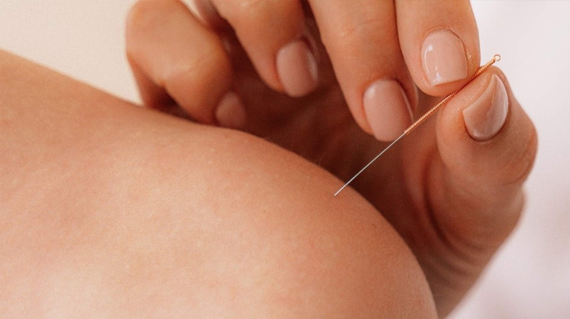 what happens when dry needling hits a nerve is it safe