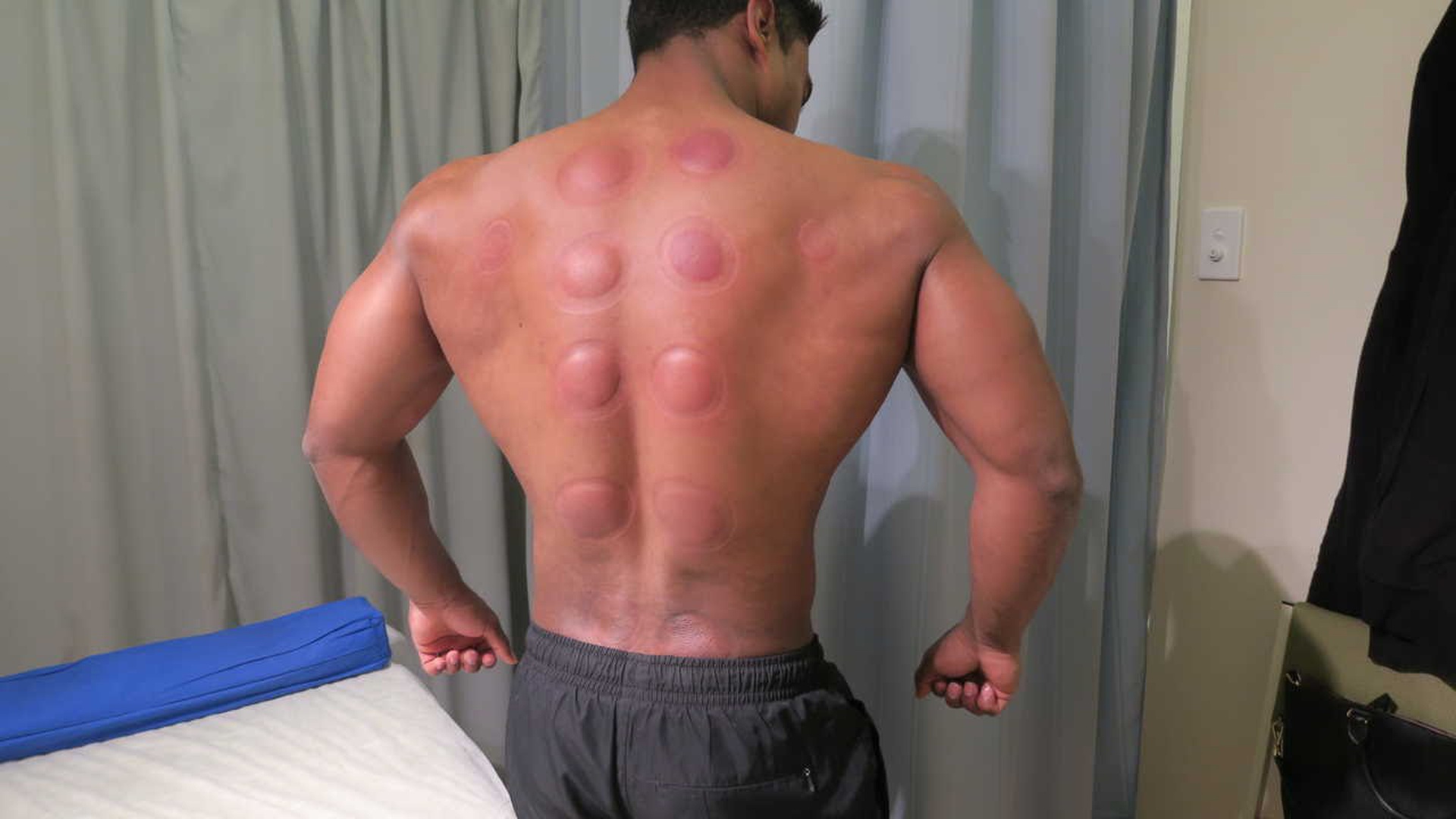 is cupping therapy painful key factors to evaluate