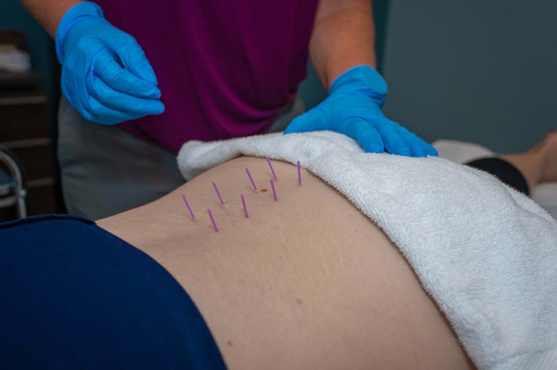 how much does dry needling hurt it depends on the level of pain