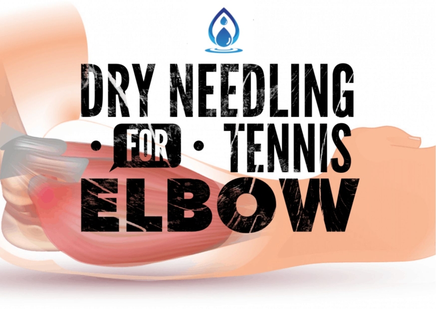 Dry Needling for Tennis Elbow A Comprehensive Guide