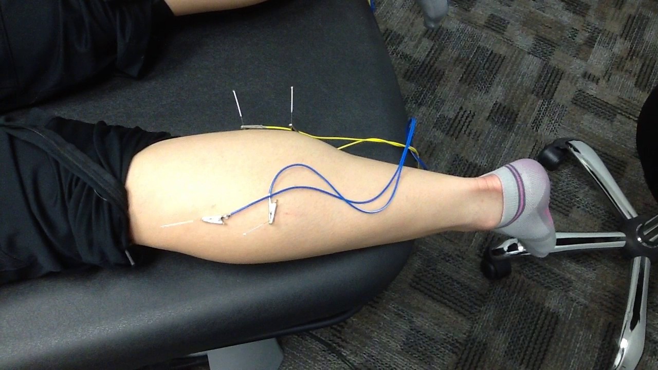 How does dry needling work on the calf?