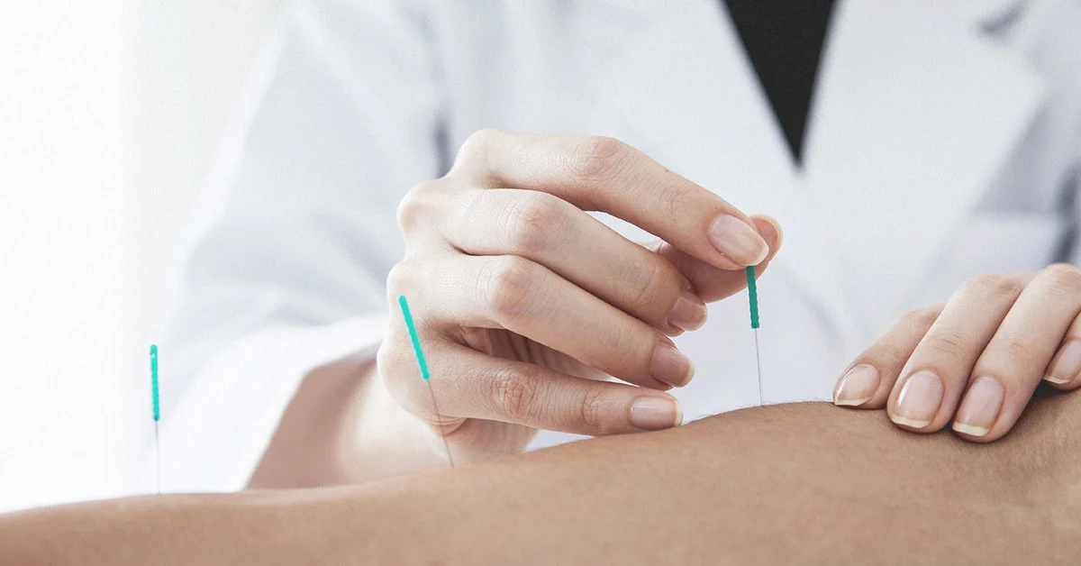 What is Dry Needling Good For? How It Can Benefit You