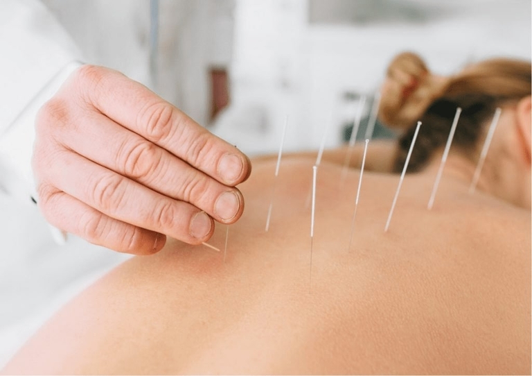 pros-and-cons-of-dry-needling-why-you-should-know