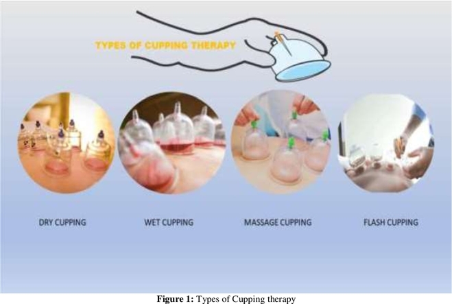 cupping-therapy-for-knee-pain 3