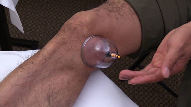 cupping-therapy-for-knee-pain