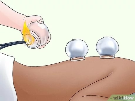 cupping-therapy-techniques
