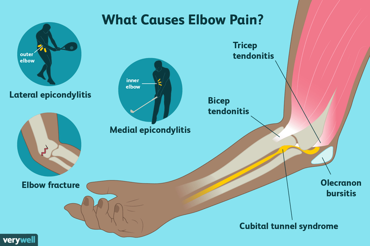 symptoms of tennis elbow