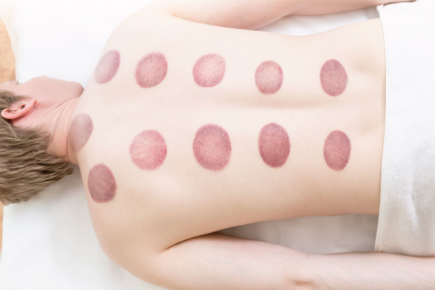 What to Do After Cupping Therapy? Recommendations 