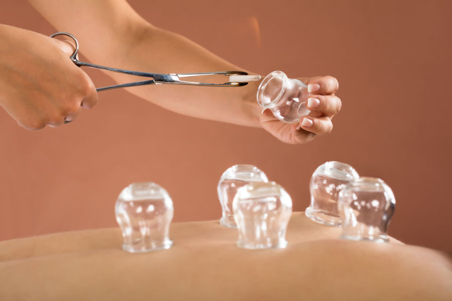 cupping-therapy